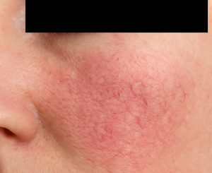 Couperose auf der Wange einer Frau im Kosmetikstudio